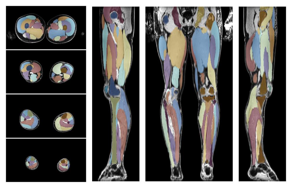 Overlay of automated muscle segmentation labels on dixon water image.